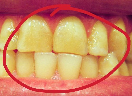 How to remove yellow teeth - CatchHow